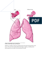 Asthma Attackopen Pop-Up Dialog Box