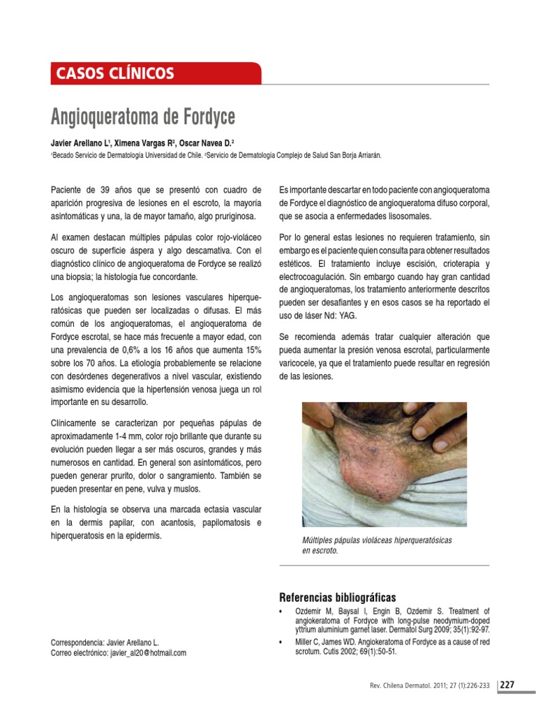Angioqueratoma de Fordyce Casos Clínicos Descargar gratis PDF