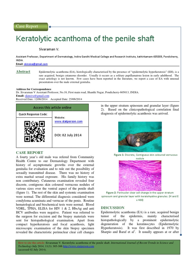 Keratolytic Acanthoma of The Penile Shaft Keratolytic Acanthoma of The
