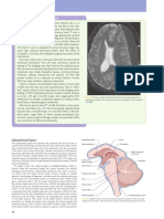 Case 3 S H: Ubdural Aematoma