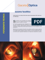 Glaucoma Facolítico