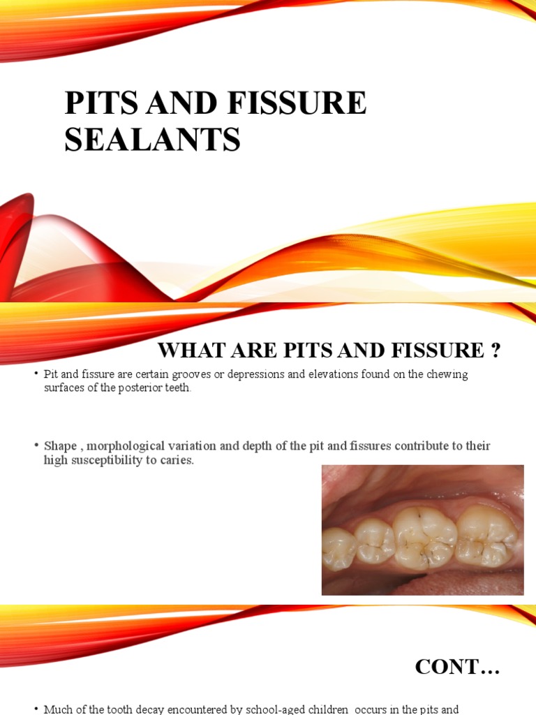 Classification, Types, and Procedure for Application of Pits and Fissure Sealants PDF Mouth