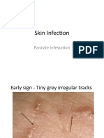 Skin Infection - Scabies