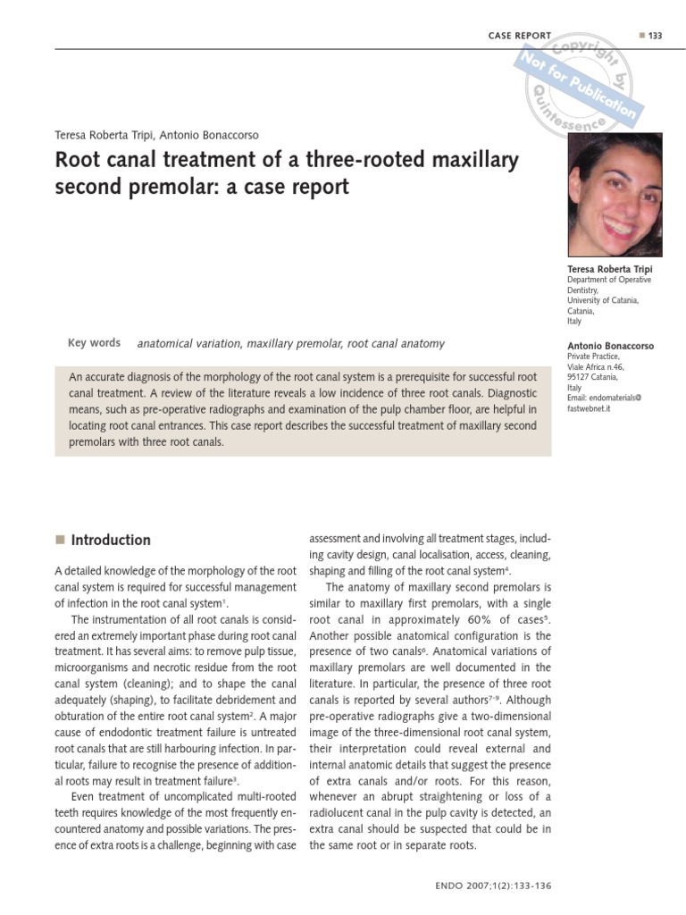 Root Canal Treatment of A ThreeRooted Maxillary Second Premolar A
