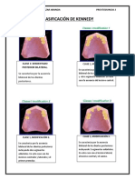 Clasificacion de Kennedy