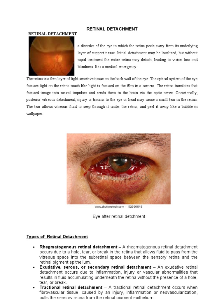 Understanding Retinal Detachment | PDF | Retina | Cataract