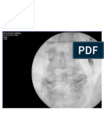 Lumber Plexus Catheter and Contrast