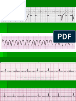 Aritmia Acls Soal Ecg