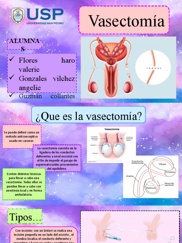 Vasectomía: Método Anticonceptivo Eficaz | PDF | Salud y bienestar
