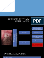 Operculectomy With Laser