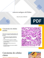 Carcinoma de Celulas Renales