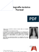 Radiografía Torácica Normal