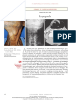 Laryngocele: Images in Clinical Medicine