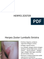 Herpes Zoster