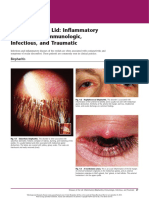 Diseases of The Lid Inflammatory (Blepharitis), Immunologic, Infectious, and Traumatic