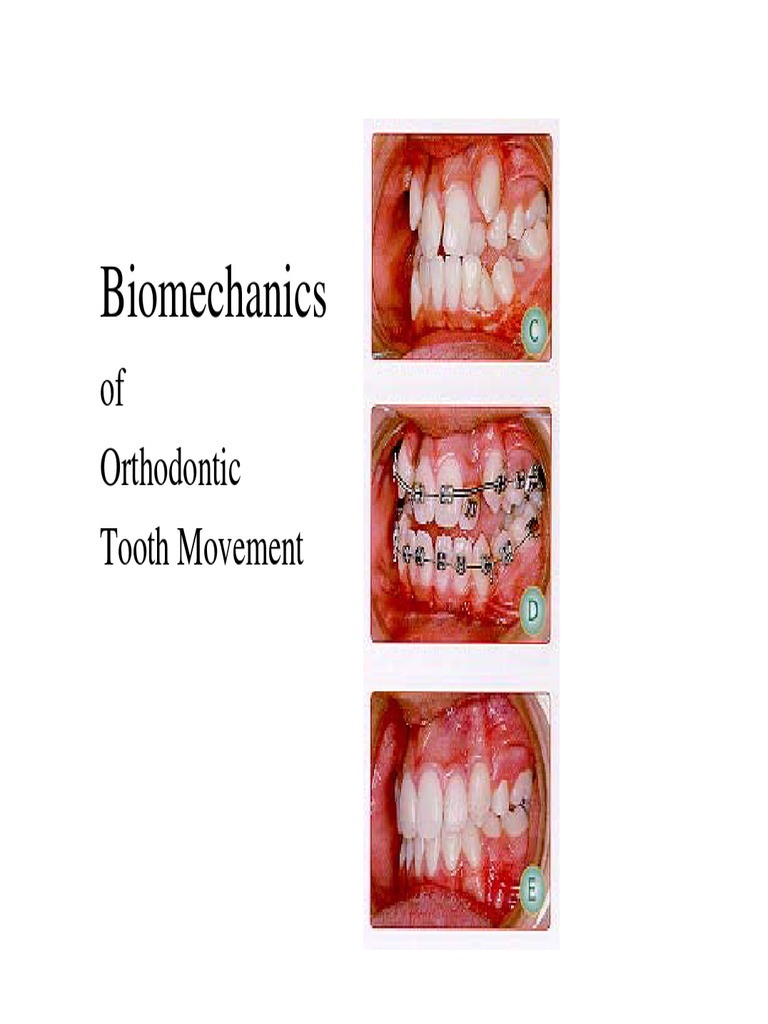 Biomechanics of Orthodontic Tooth Movement PDF Bone Osteoblast