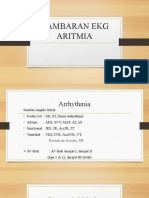 Gambaran Ekg Aritmia