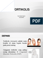 Tortikolis