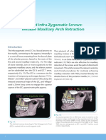 Guided Infra-Zygomatic Screws: Reliable Maxillary Arch Retraction
