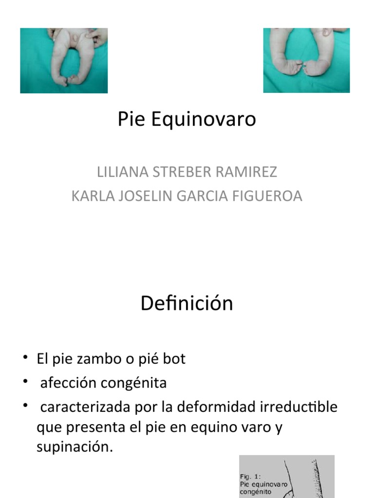 Pie Equinovaro PDF