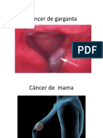 El Cáncer de Garganta