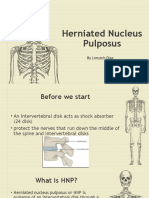 Herniated Nucleus Pulposus: by Limytch Diaz