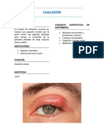 Chalazion