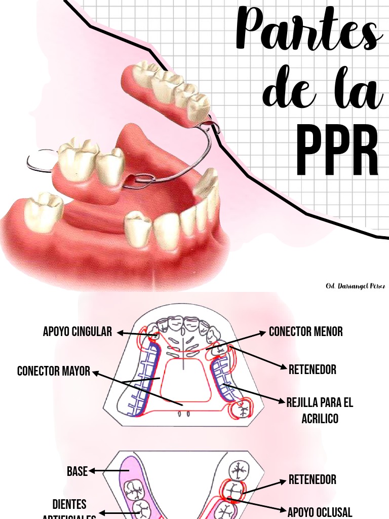 Componentes de la PPR Dental | PDF | Dentadura postiza | Ramas de ...