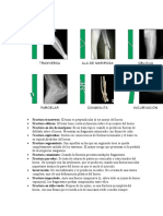 Fractura Transversa