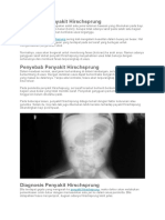 Pengertian dan Penyebab Penyakit Hirschsprung