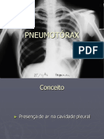 Pneumotorax