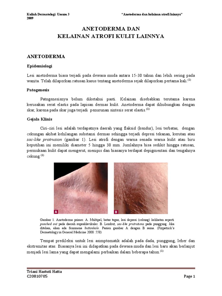 Anetoderma Dan Kelainan Atrofi Kulit Lainnya | PDF