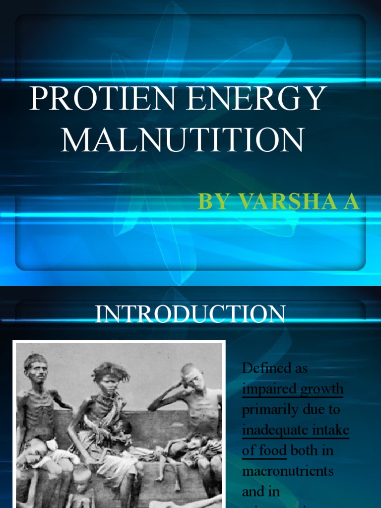 ProteinEnergy Malnutrition PDF Malnutrition Nutrition