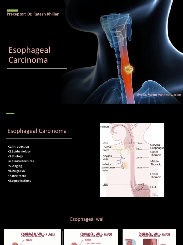 Esophageal Cancer Overview | PDF | Esophageal Cancer | Esophagus
