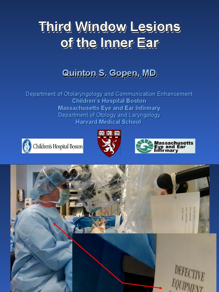 Third Window Lesions Overview | PDF | Ear | Vertigo