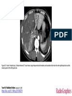 Large Hematoma and Lacerations on CT After Severe Hepatic Injury