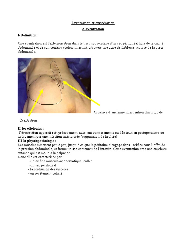 Éventration et Éviscération Définitions et Traitements PDF — free download