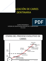 Estabilizacíon de Caries Dentinaria