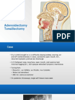 Adenotonsillectomy