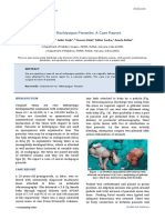 Sacral Rachipagus Parasite: A Case Report