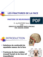 Les Fractures de La Face