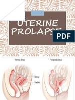 Uterine Prolapse: Prepared by Dipti Punjal