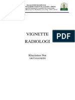 Vignette Thorax - Bronchiectasis - Khaziatun Nur - 1807101030059