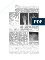 Artritis Reumatoide