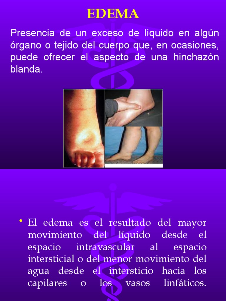 Edema y líquido intravascular | PDF