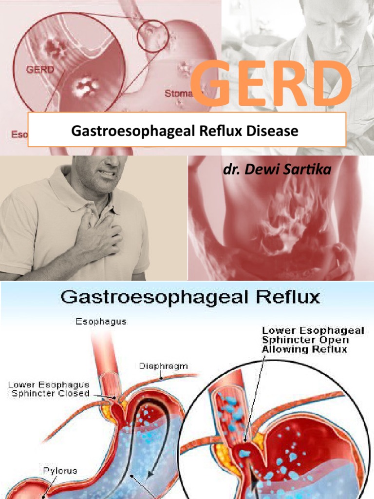 GERD Overview: Statistics and Treatments | PDF | Gastroesophageal ...