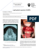 Surgically Assisted Rapid Palatal Expansion (SARPE)