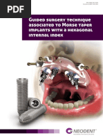 Guided Surgery Technique Associated To Morse Taper Implants With A Hexagonal Internal Index