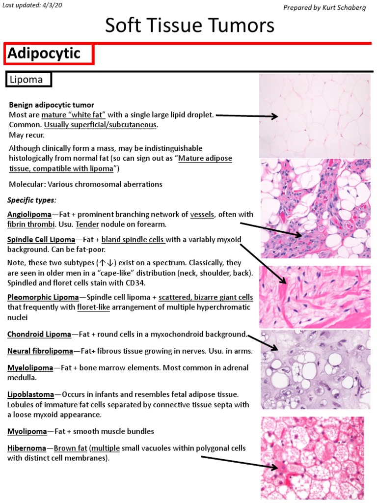 Spindle cell lipoma. (A) A fatty-tumor with interspersed fibro-myxoid