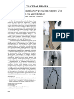 Albrecht-2004-Traumatic Peroneal Artery Pseudo